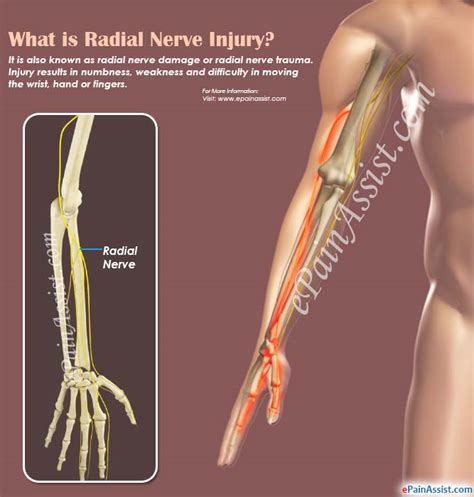 What Is Radial Nerve Injurycausessymptomstreatmentprognosisdiagnosis