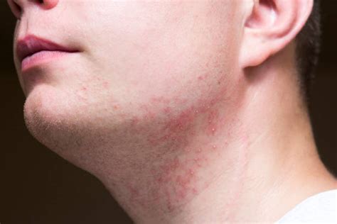 Skin Irritation Stock Photos Pictures And Royalty Free Images Istock