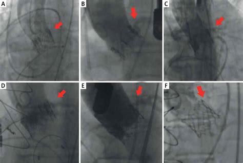 Percutaneous Access To Coronary Arteries In Patients After