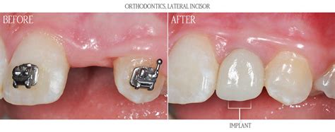 Before And After Gallery Asird American Society Of Implant And