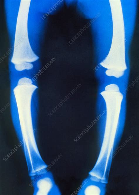 Coloured X Ray Of The Legs Of A Child With Rickets Stock Image M250