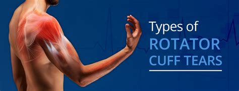 Types Of Rotator Cuff Tears Orthobethesda