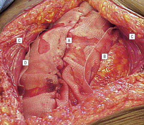 ventral umbilical hernia
