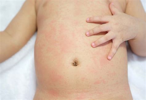 Zika Virus Infections In Babies And Kids Symptoms Treatment And Prevention