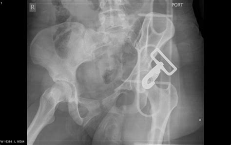 Pelvic Fracture Shear Injury And Shear Mechanism Radrounds