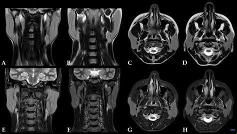 Mri Assessment Shows Reduction Of The Parotid Gland Volume Bilaterally