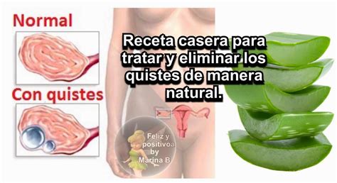 Remedio Casero Para Tratar Y Eliminar Los Quistes De Manera Natural Tips