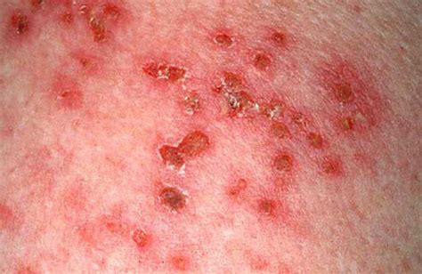 Herpes Zoster Rash On Leg Shingles Picture Hardin Md Super Site Sample Although Shingles