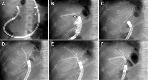 Multiple Plastic Stent Placements For Benign Biliary Strictures After