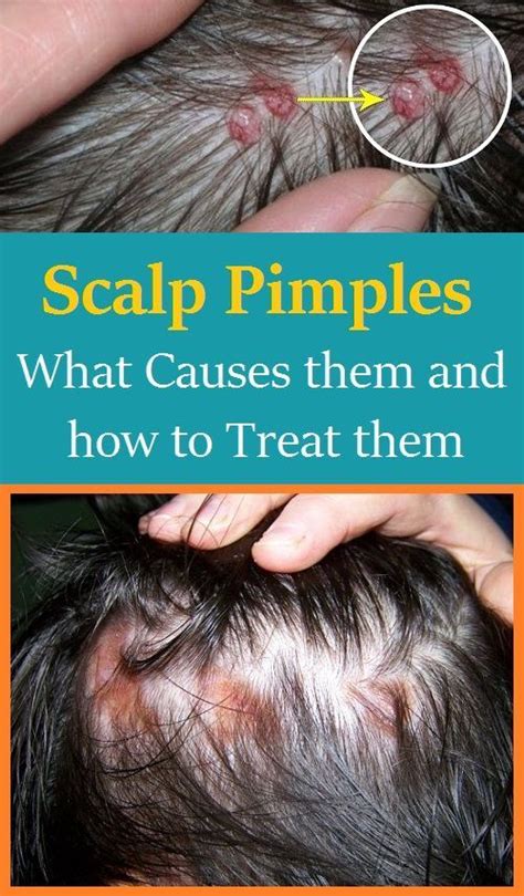 Scalp Pimples What Causes Them And How To Treat Them Pimples On Scalp Pimples Scalp Acne