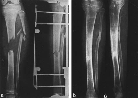 Extensive Bone Loss In An Open Tibial Shaft Fracture Immediate Bone