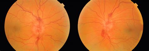 Bilateral Optic Disc Swelling As A Presenting Sign Of Superior Sagittal