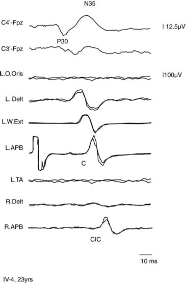 Cortical Myoclonus And Epilepsy Overlap And Differences Neupsy Key