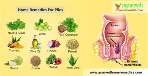 10 Best Home Remedies For Treating Piles How To Get Rid Of Hemorrhoids