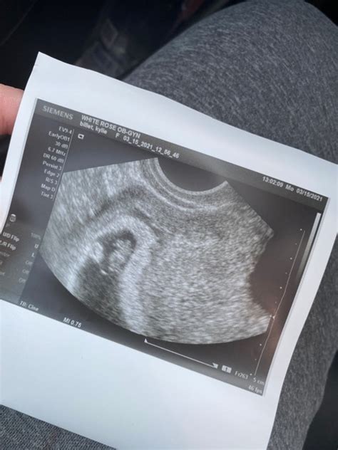 Does My Ultrasound Look Normal For 8 Weeks I Was Told This Looks