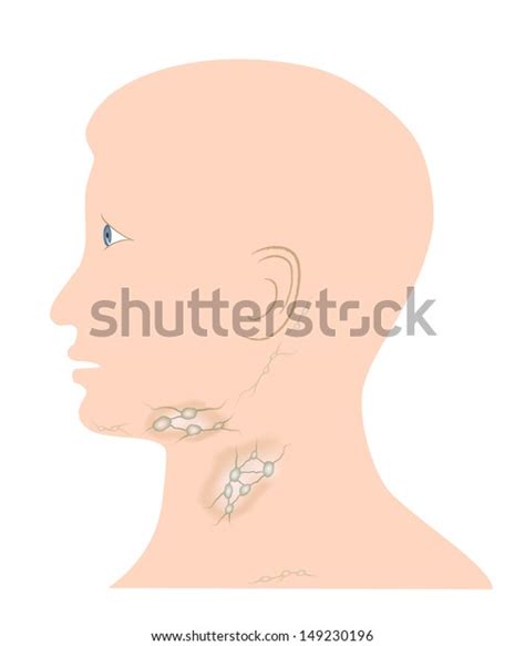 Ilustración De Stock Sobre Swollen Lymph Nodes 149230196