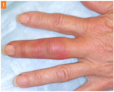 What Is Causing This Womans Swollen Red And Tingling Finger