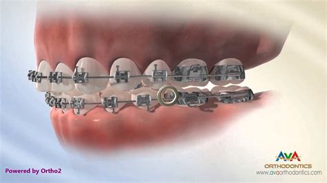 How To Put Rubber Bands On Braces For Crossbite Orthodontic Headgear