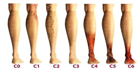 Varicose Veins Of The Lower Extremities Treatment Symptoms Photos