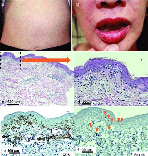 Clinical Appearances The Patient Developed A Maculopapular Rash On