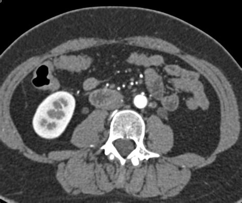 Transitional Cell Cancer Tcc Left Distal Ureter Genitourinary Case