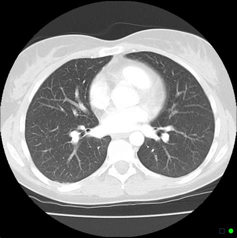 Chest Ct Scan Images Dataset Kaggle