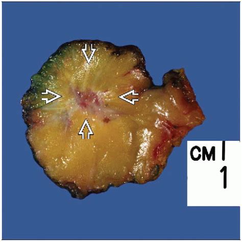 Radial Sclerosing Lesionradial Scar Basicmedical Key