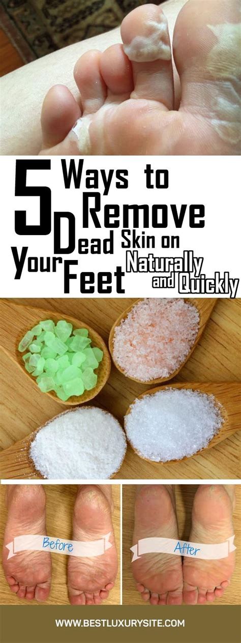 How To Get Rid Of Dead Skin On Feet There Is A Big Chance That You
