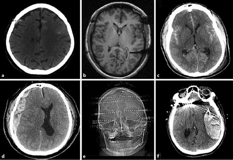 Hemorrhagic Complications A Small Right Subdural And Left Subarachnoid