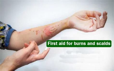 First Aid For Burns And Scalds Health Vision