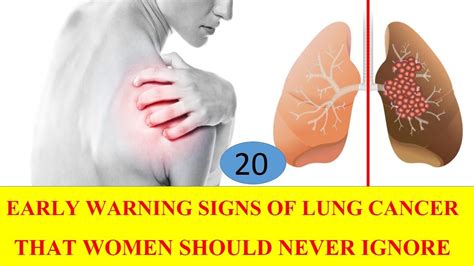 20 Early Warning Signs Of Lung Cancer That Women Should Never Ignore Youtube