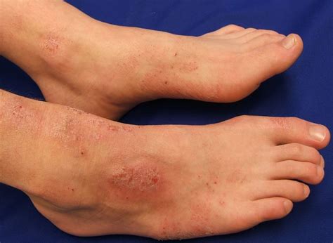Dermatitis Atopik Penyebab Gejala Dan Cara Mengobati Idn Medis