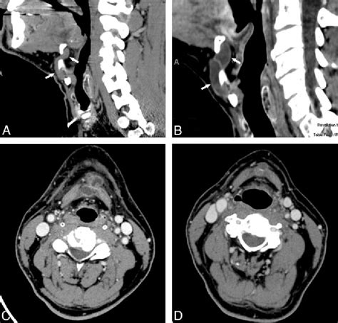 Figure 2 From Enlargement And Transformation Of Thyroglossal Duct Cysts