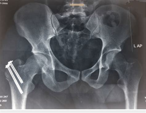 Post Operative Plain Radiograph Of The Pelvis With Bilateral