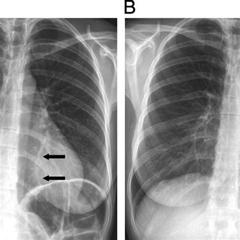 A Chest X Ray On Admission Few Ground Glass Opacities In The Right