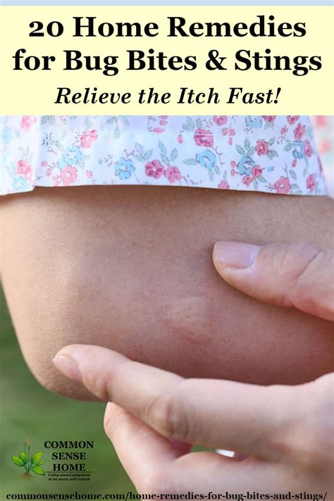 20 Home Remedies For Bug Bites And Stings That Itch And Swell