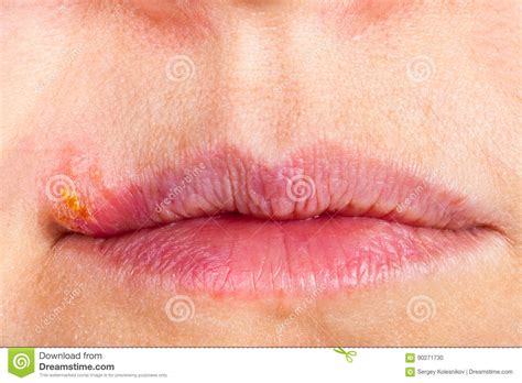 Herpes On The Lip Close Up Macro Stock Photo Image Of Human Face