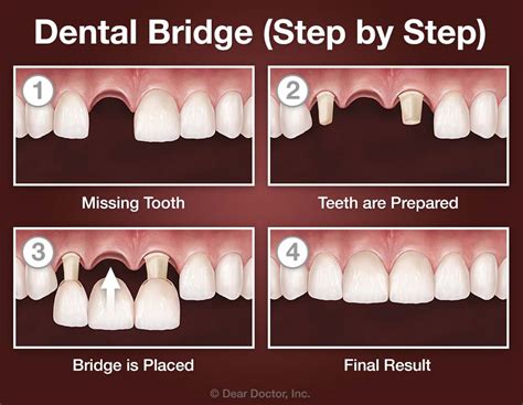 Dental Bridges Northwest Dental Glyndon Maryland