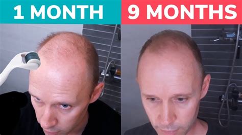 Stop Balding Regrow Hair Naturally With Dermaroller Real 9 Month