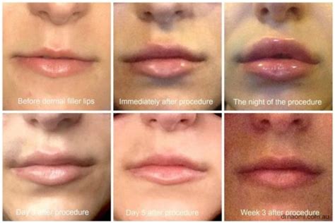Dermal Filler In Lips Picture Diary Best Clinic Sydney For Dermal Fillers