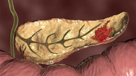 Pancreatic cancer arises when cells in the pancreas, a glandular organ behind the stomach, begin to multiply out of control and form a mass. Most Deadly Form of Pancreatic Cancer Reveals Potential ...