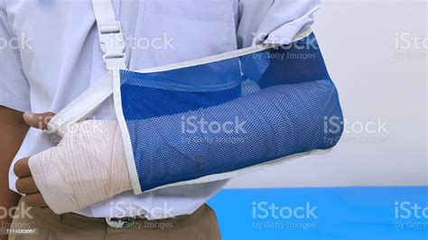 Patient S Broken Bone Treatment By Orthopedic Arm Cast And