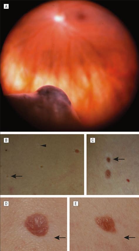 Cutaneous Halo Nevi Following Plaque Radiotherapy For Uveal Melanoma