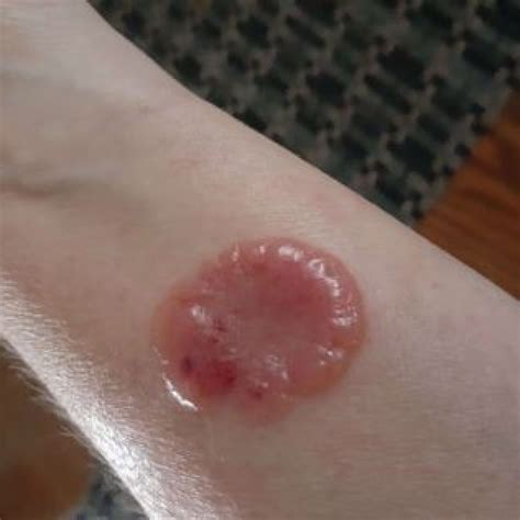 Eosinophilic Cellulitis A Mysterious Case Of Flower Shaped Lesions