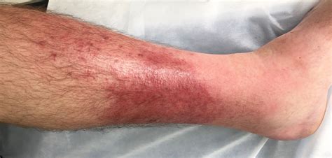 ≡ Warning Signs Of Cellulitis And How To Prevent It 》 Life 360 Tips