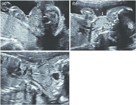 Ac Ultrasound Scans Of Fetal Goiter At 23 Gestational Weeks Thyroid