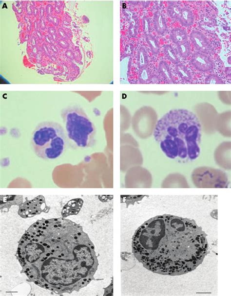 Gut Histology And Neutrophil Morphology In Our Patient With Neutrophil