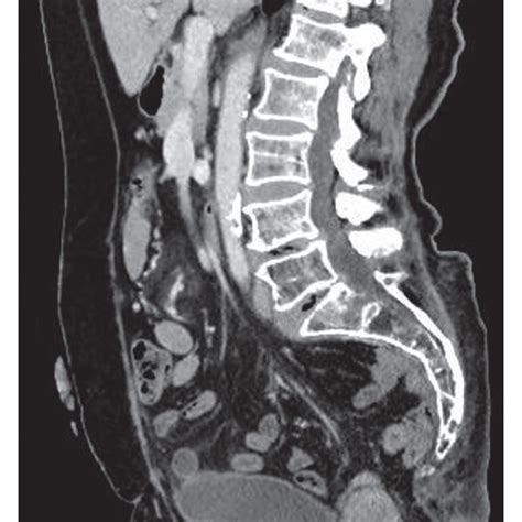 The Sagittal Image Of The Pelvis After Perineal Hernia Repair