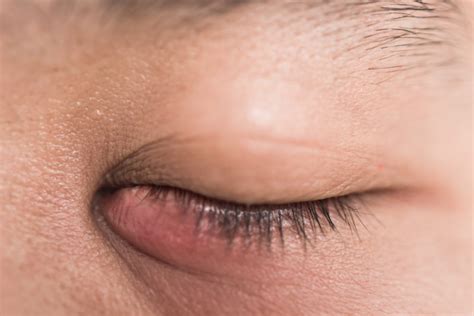 Blocked Tear Duct Symptoms Causes And Treatment Diamond Vision