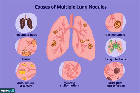 Do Lung Nodules Turn Into Cancer CancerWalls
